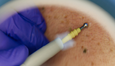 Close up of specialized equipment used in skin cancer screenings.
